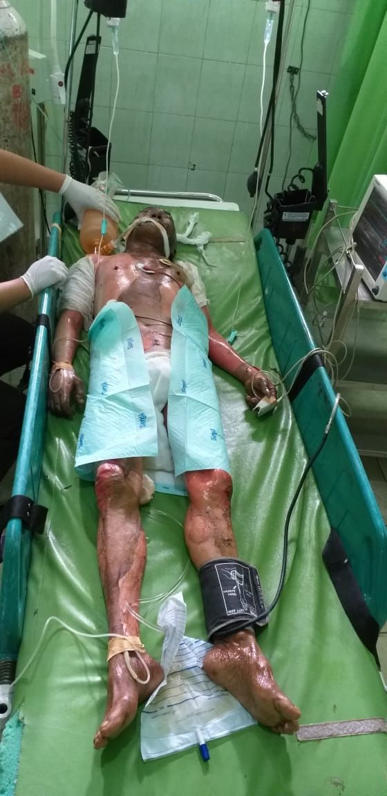 M Yunis Mengalami Luka Bakar Serius Akibat Rumah Kontrakannya Terbakar
