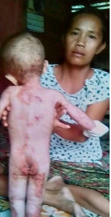 Kondisi Balita Desa yang Mulai Membaik Foto Sebelum diberi Pengobatan