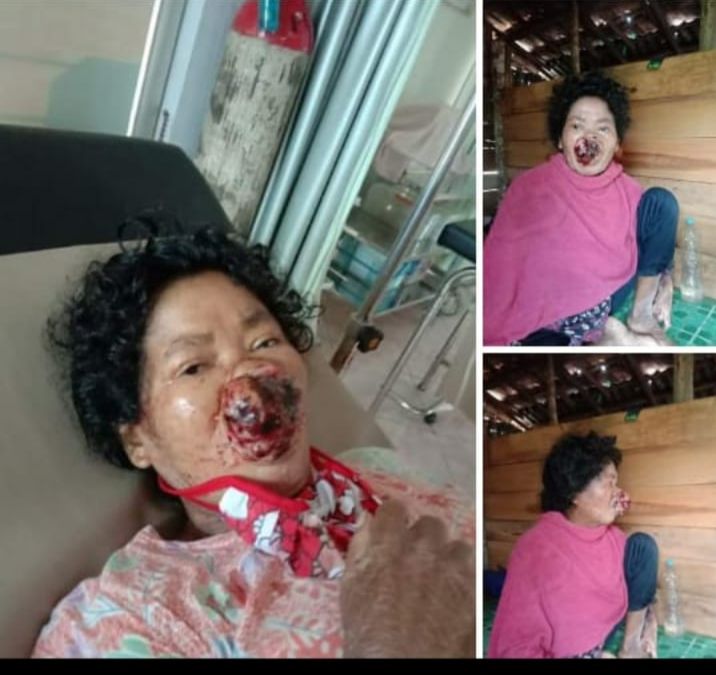 Ibu Enek penderita Tumor .